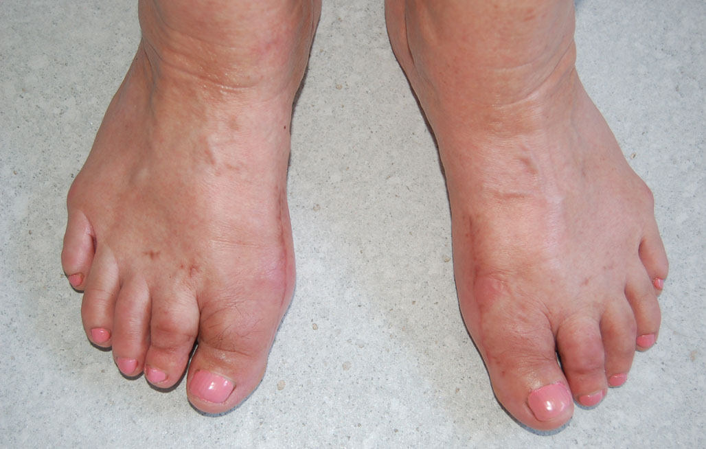 stopy po operacji haluksów