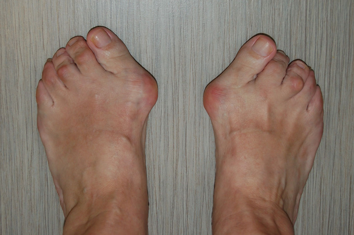 Zaawansowana deformacja stopy