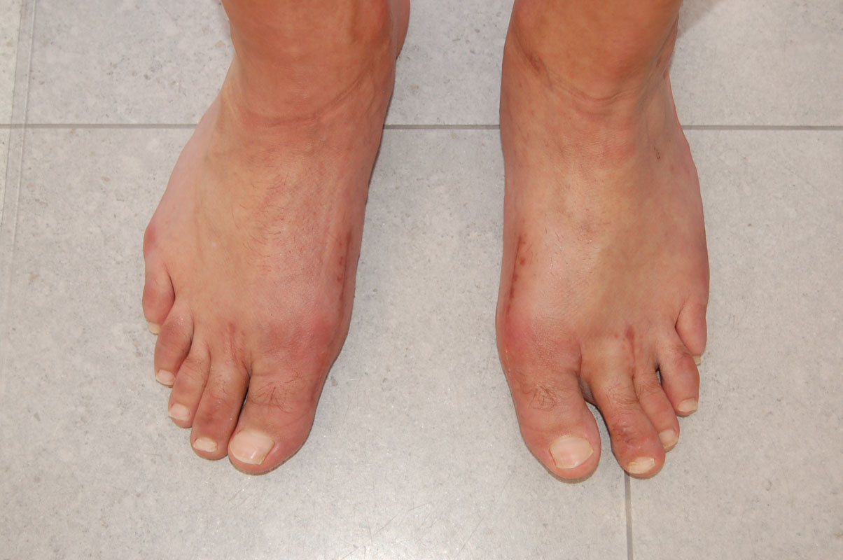 Męskie stopy po operacji haluksa