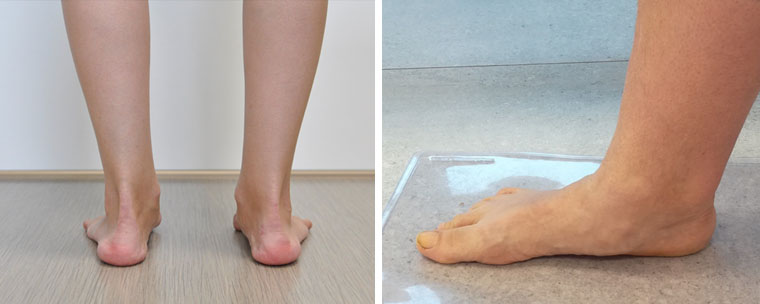 Objawy stopy płaskiej